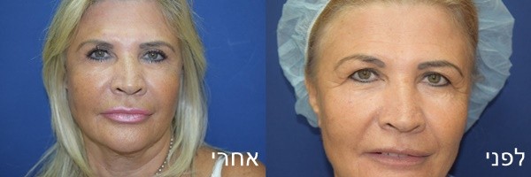ניתוח עפעפיים לפני ואחרי
