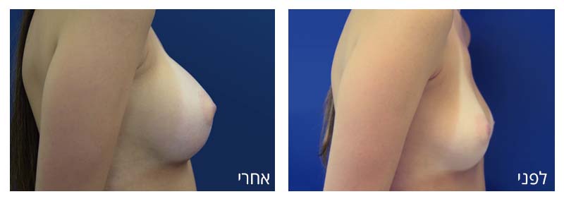 Eden_SIDE הגדלת חזה לפני ואחרי