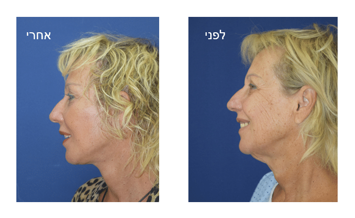 ניתוח מתיחת צוואר